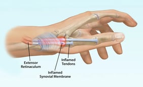 Tenosynovitis