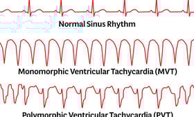 Ventricular Tachycardia