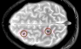 Concussions: Symptoms and Treatment