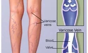 Understanding Varicose Veins: The Basics