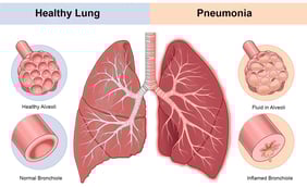 Pneumonia: What to Know