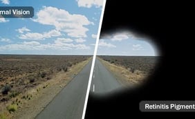 What Is Retinitis Pigmentosa?