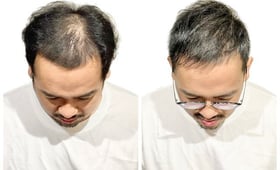 專家告訴你：如何選擇適合自己的植髮技術和醫院？