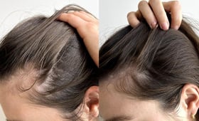 植髮後遗症有哪些?一次看懂植髮手術風險及植後遗症!