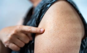 Smallpox: Symptoms, Spread, and Treatment