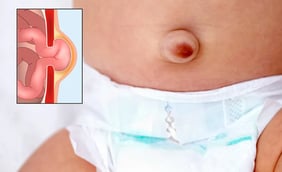 Umbilical Hernia